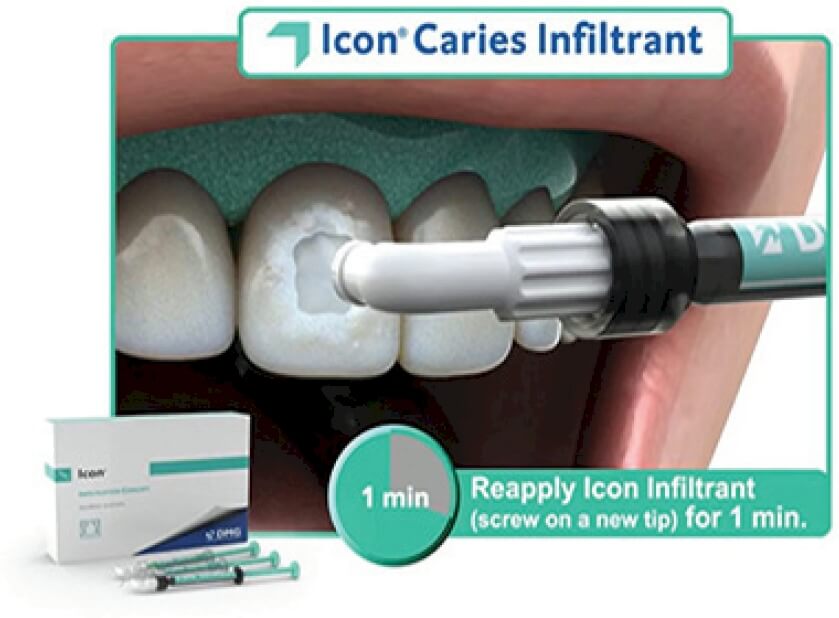 Icon Caries Infiltrant